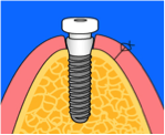 Implantat_Ablauf_Step4