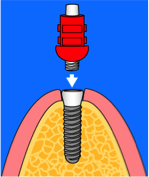 Implantat_Ablauf_Step5