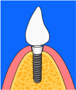 Implantat_Ablauf_Step8